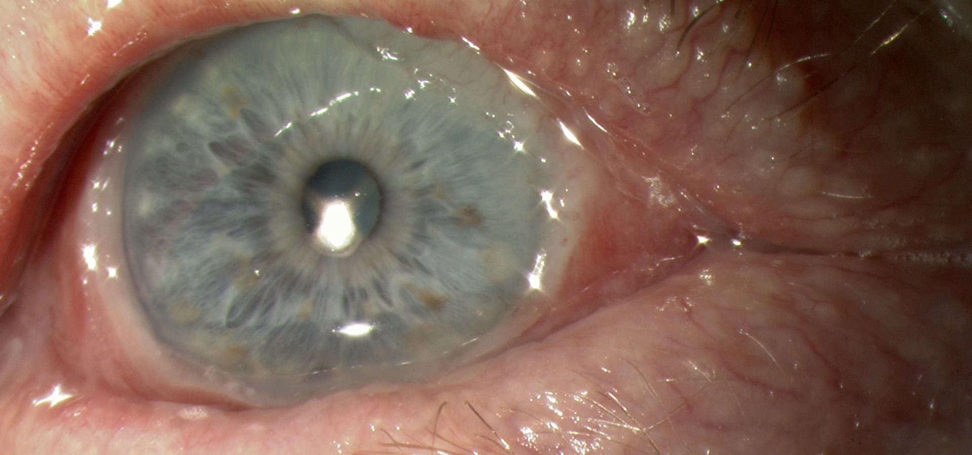 Ocular Pemphigoid