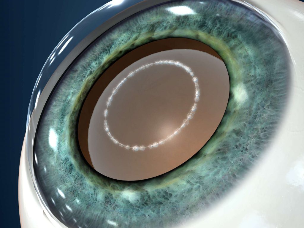 Laser cataract surgery
